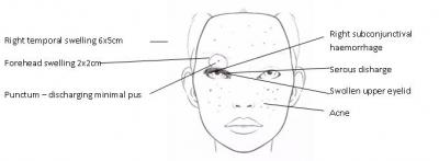 Figure 1: Diagram of face showing the location of the forehead swelling (abscess) with purulent discharge punctum.